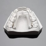 palatal expander